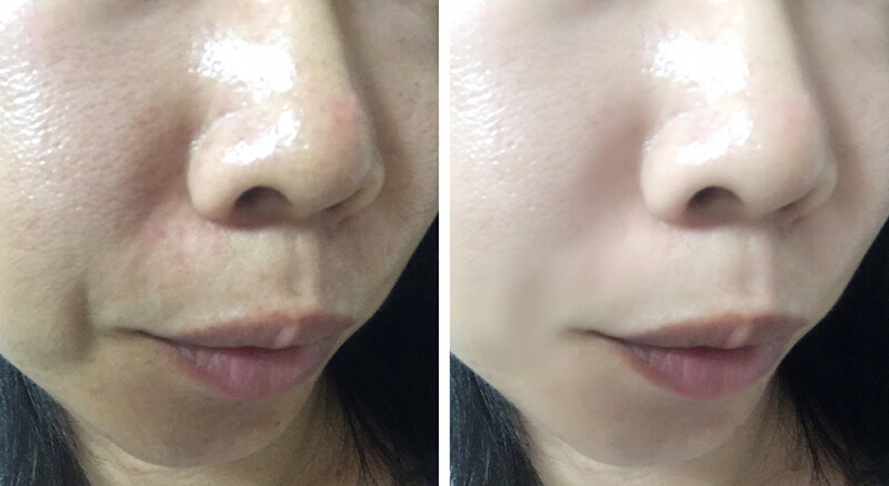 肌質改善ビフォーアフター